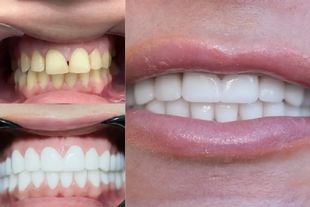 Is A1 tooth shade good for your smile?