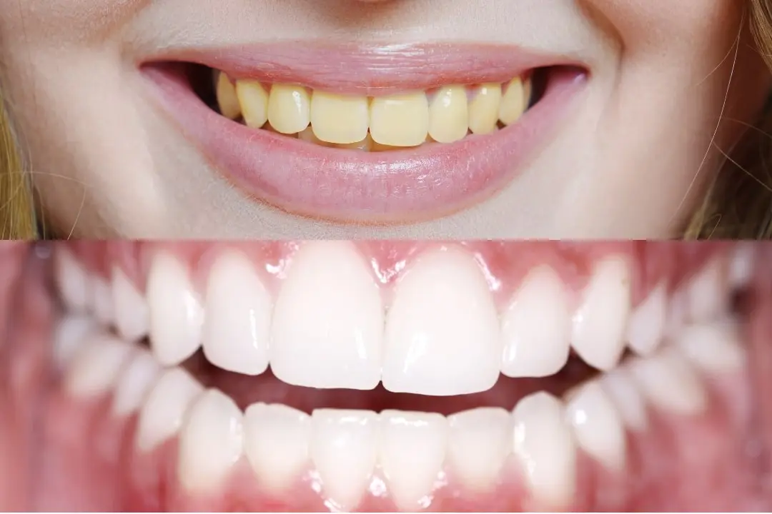 Can air polishing teeth remove all types of stains? Can air polishing teeth remove all types of stains?