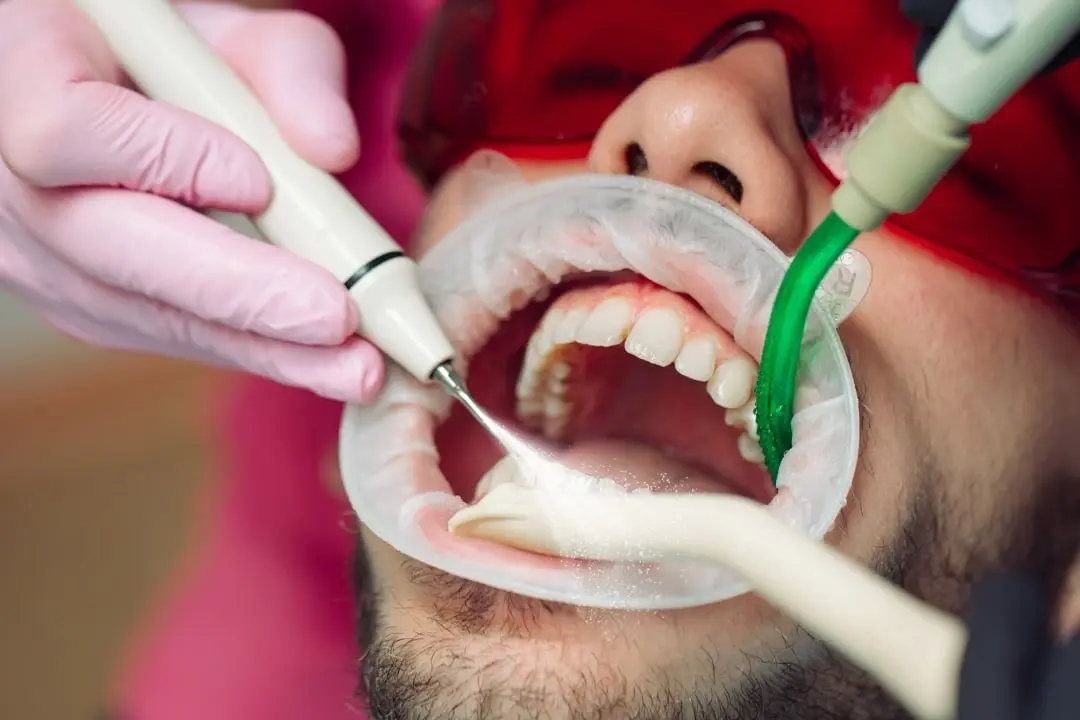 Airflow cleaning teeth cleaning