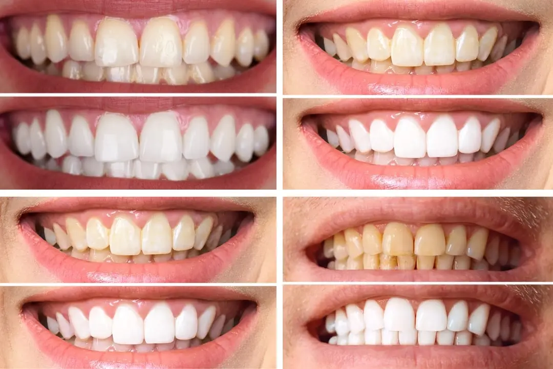 Airflow teeth cleaning before after Airflow teeth cleaning before after in Antalya, Turkey