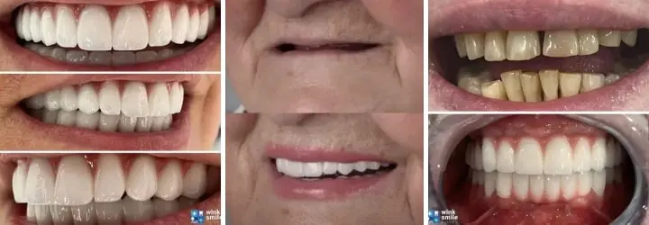 All on 4 dental implants before after All on 4 dental implants before after Antalya, Turkey