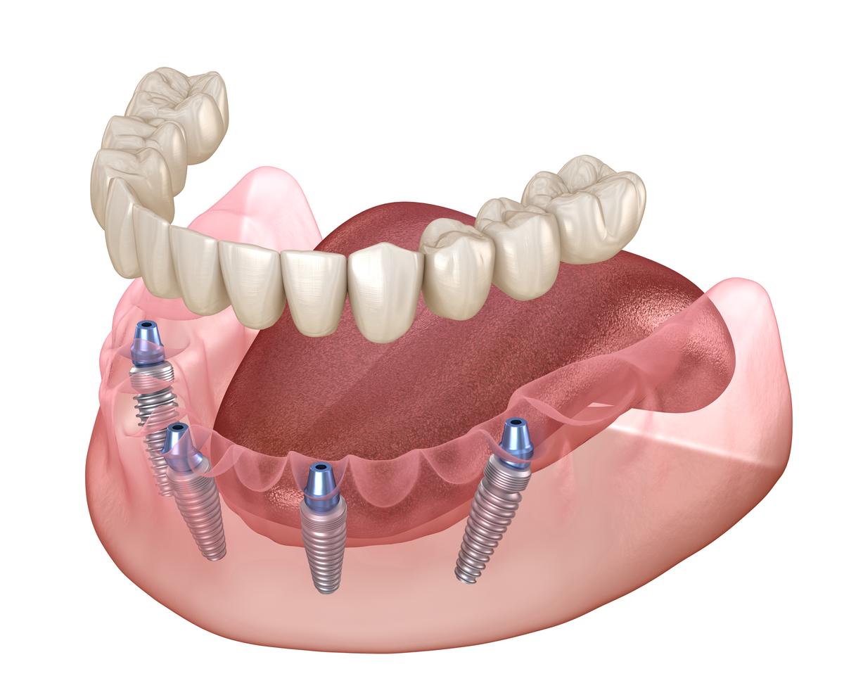 All on 4 dental implant