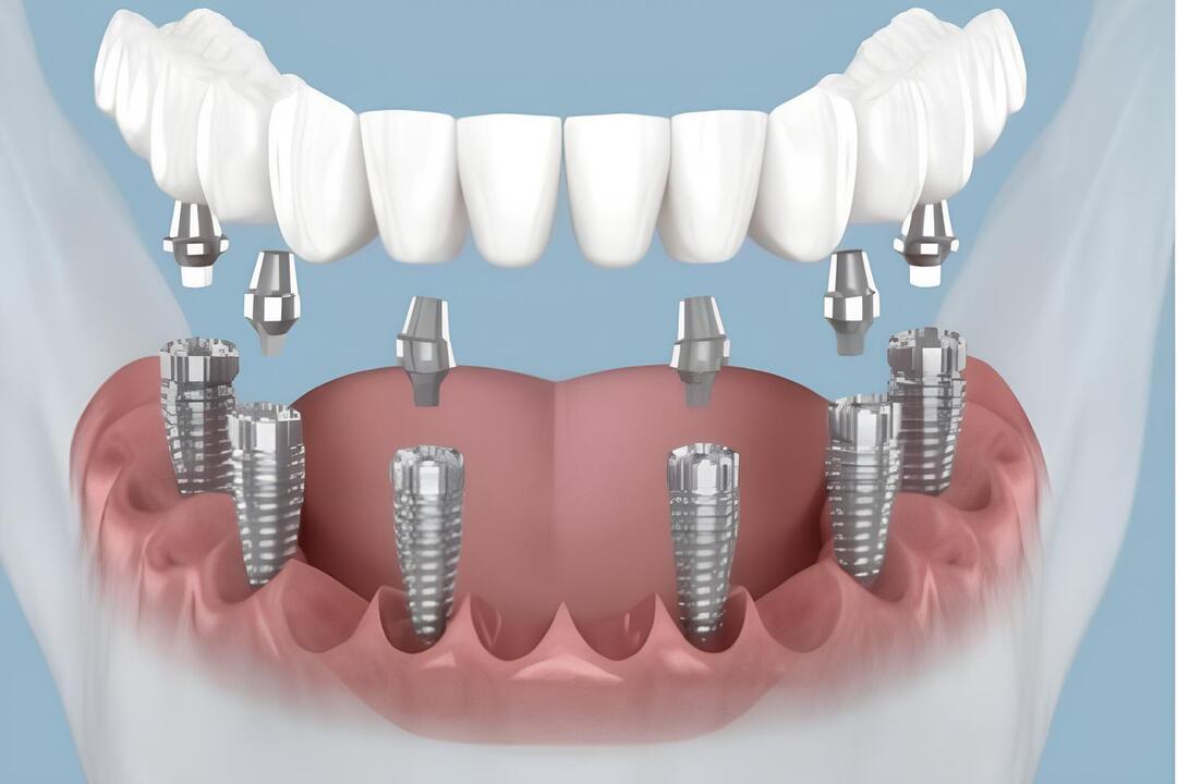 all-on-6-dental-implant