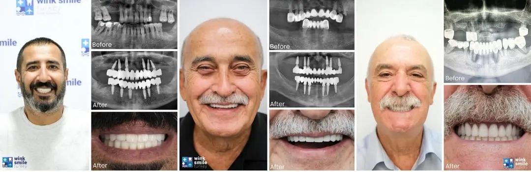 All on 6 dental implants before after All on 6 dental implants before after Antalya, Turkey