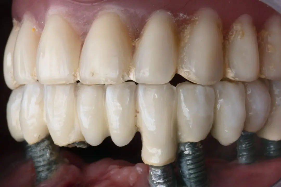 All on 6 dental implant problems All on 6 dental implant problems