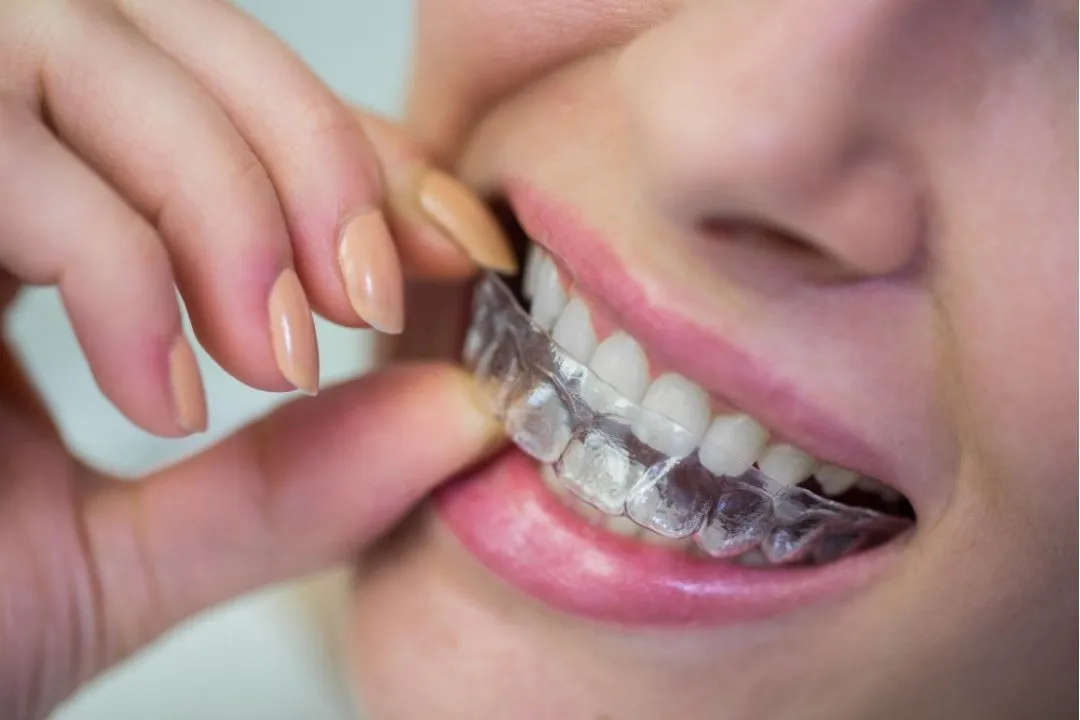 Can Invisalign Fix an Overbite?