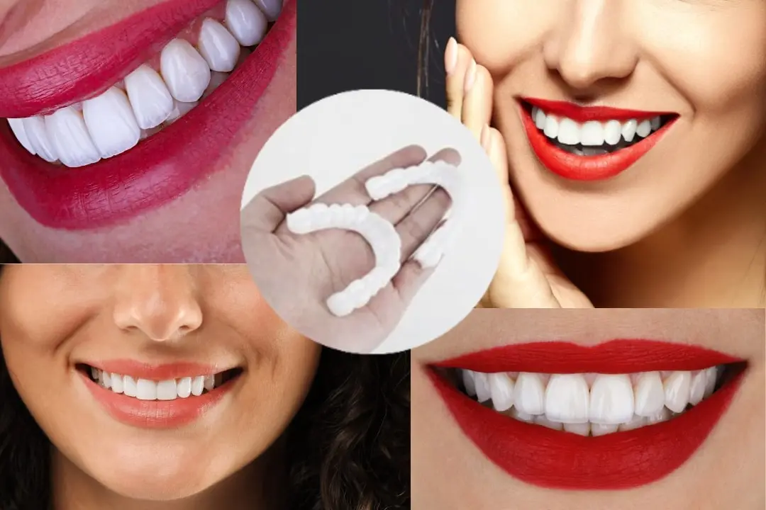 How long do veneers last?