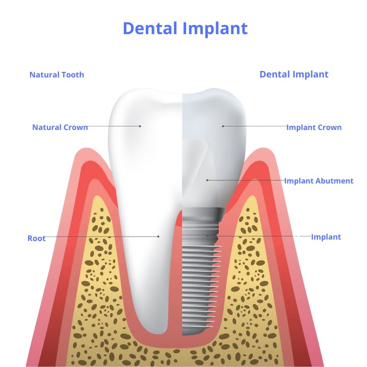 dental-implant