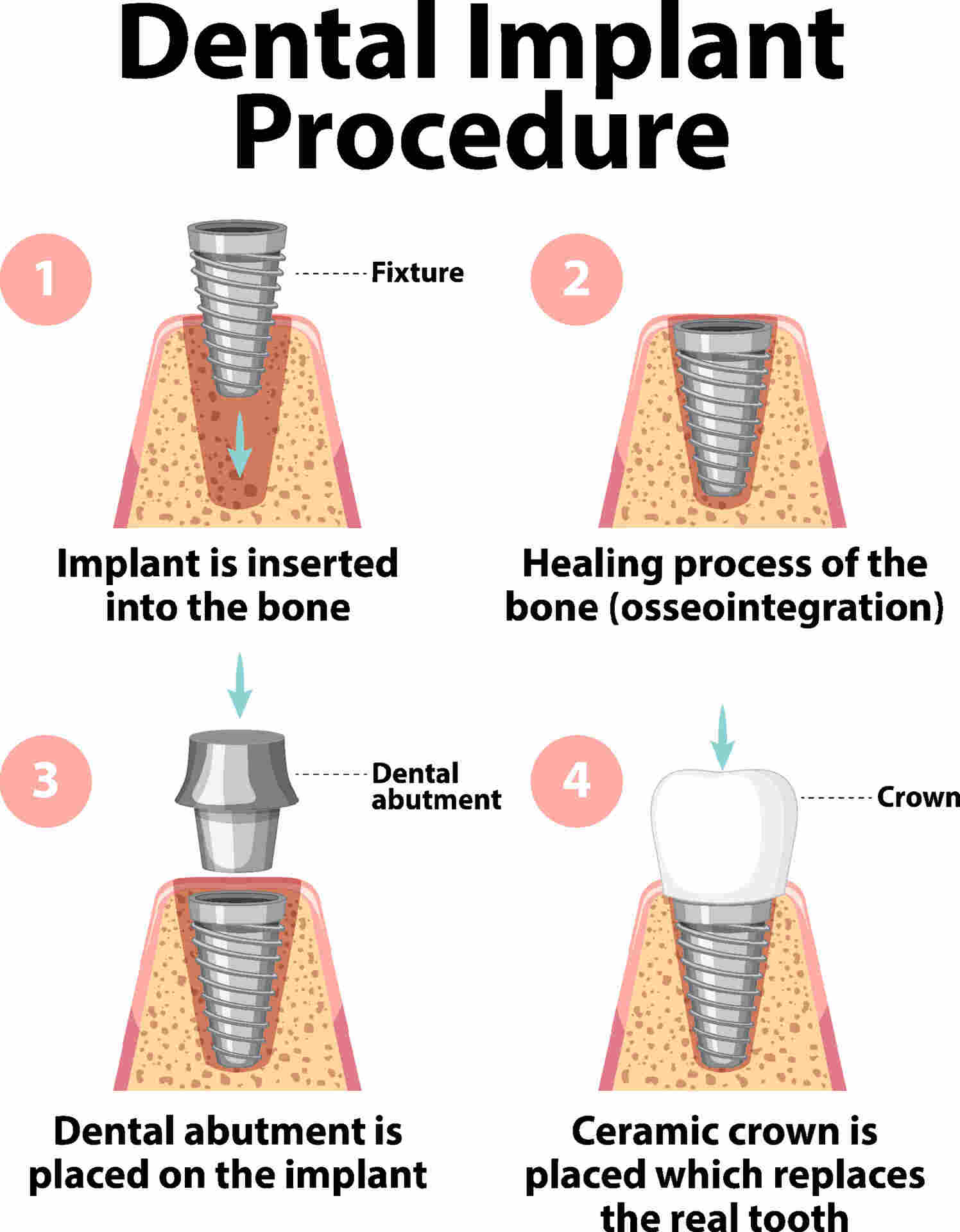 dental implant procedure