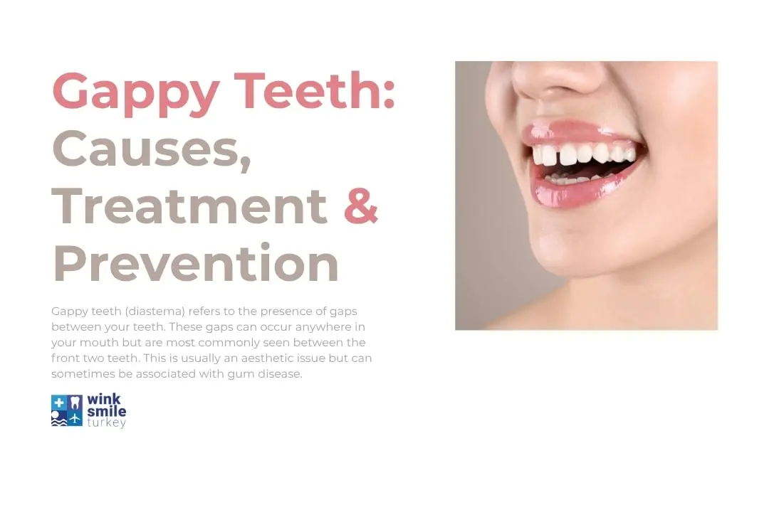 What is gappy teeth?