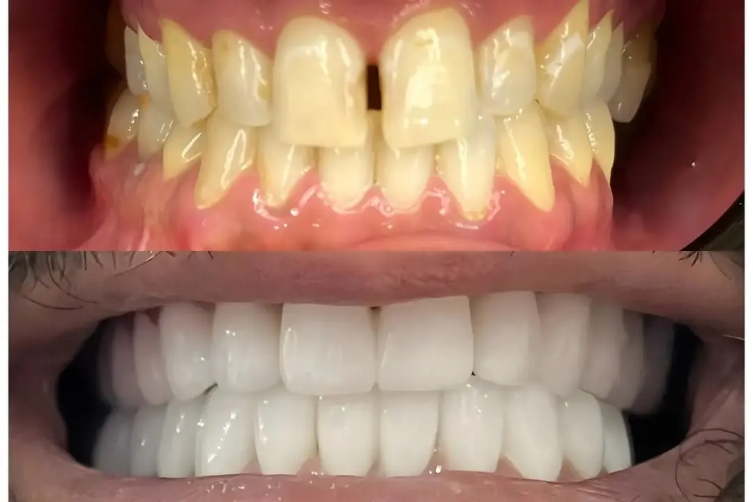What is gappy teeth? What is gappy teeth?