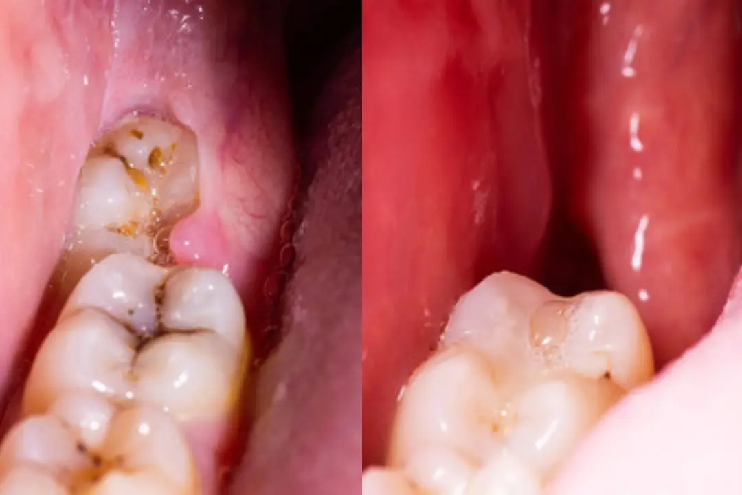 Healthy Socket After Tooth Extraction