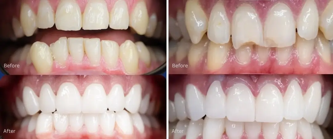 Hollywood Smile before after Antalya, Turkey Hollywood Smile before after Antalya, Turkey