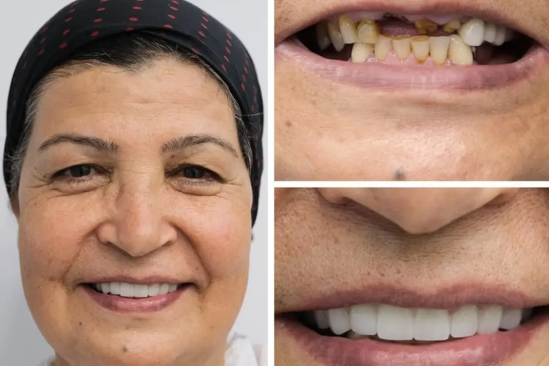 Dental implants Dental implants