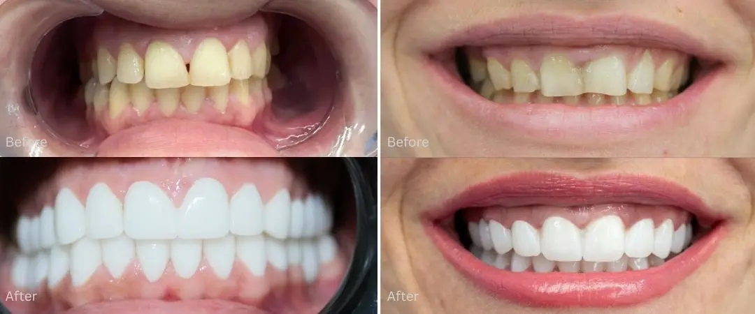 Hollywood Smile before after Antalya, Turkey Hollywood Smile before after Antalya, Turkey