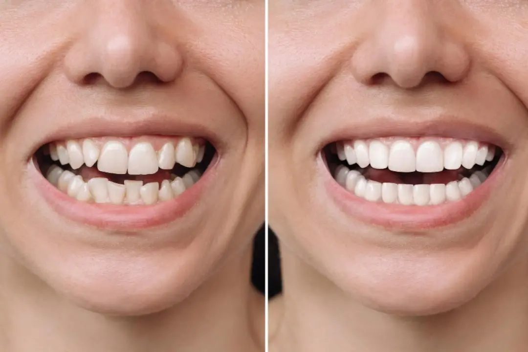 Invisalign Invisalign