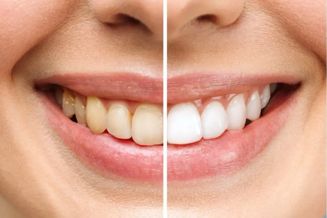 Teeth whitening Teeth whitening