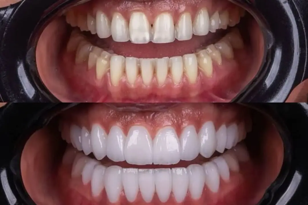 Dental veneers Dental veneers