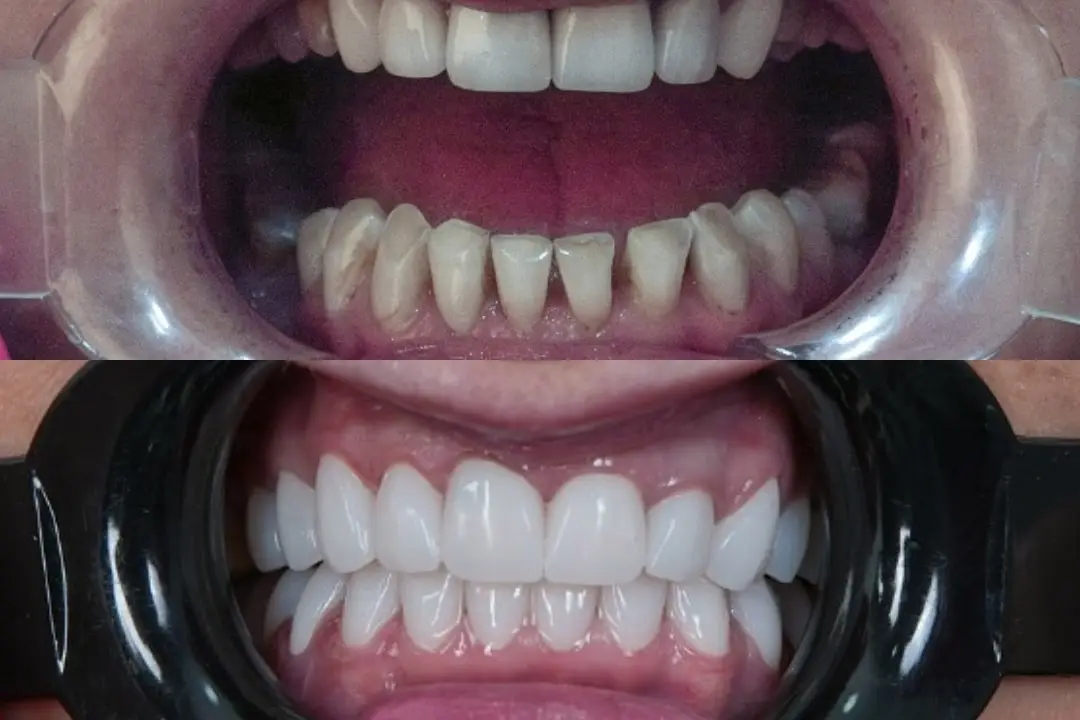 Zirconium crown Zirconium crown