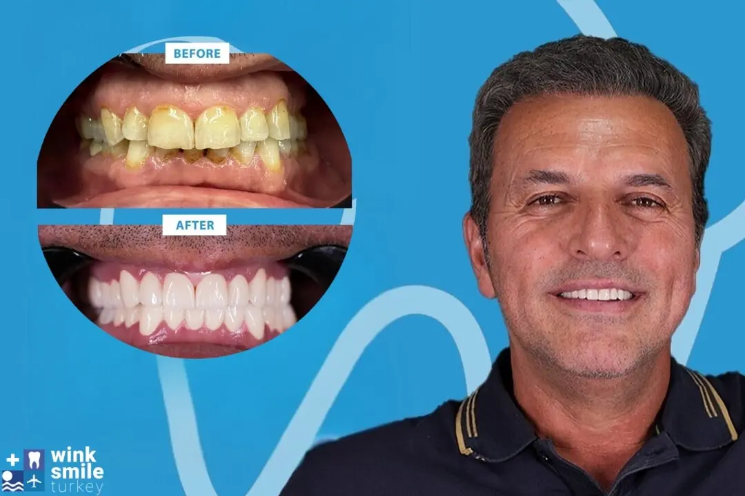 How long do veneers last?