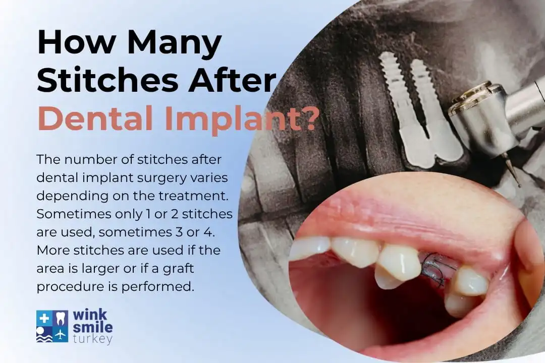 How Many Stitches After Dental Implant? Antalya, Turkey