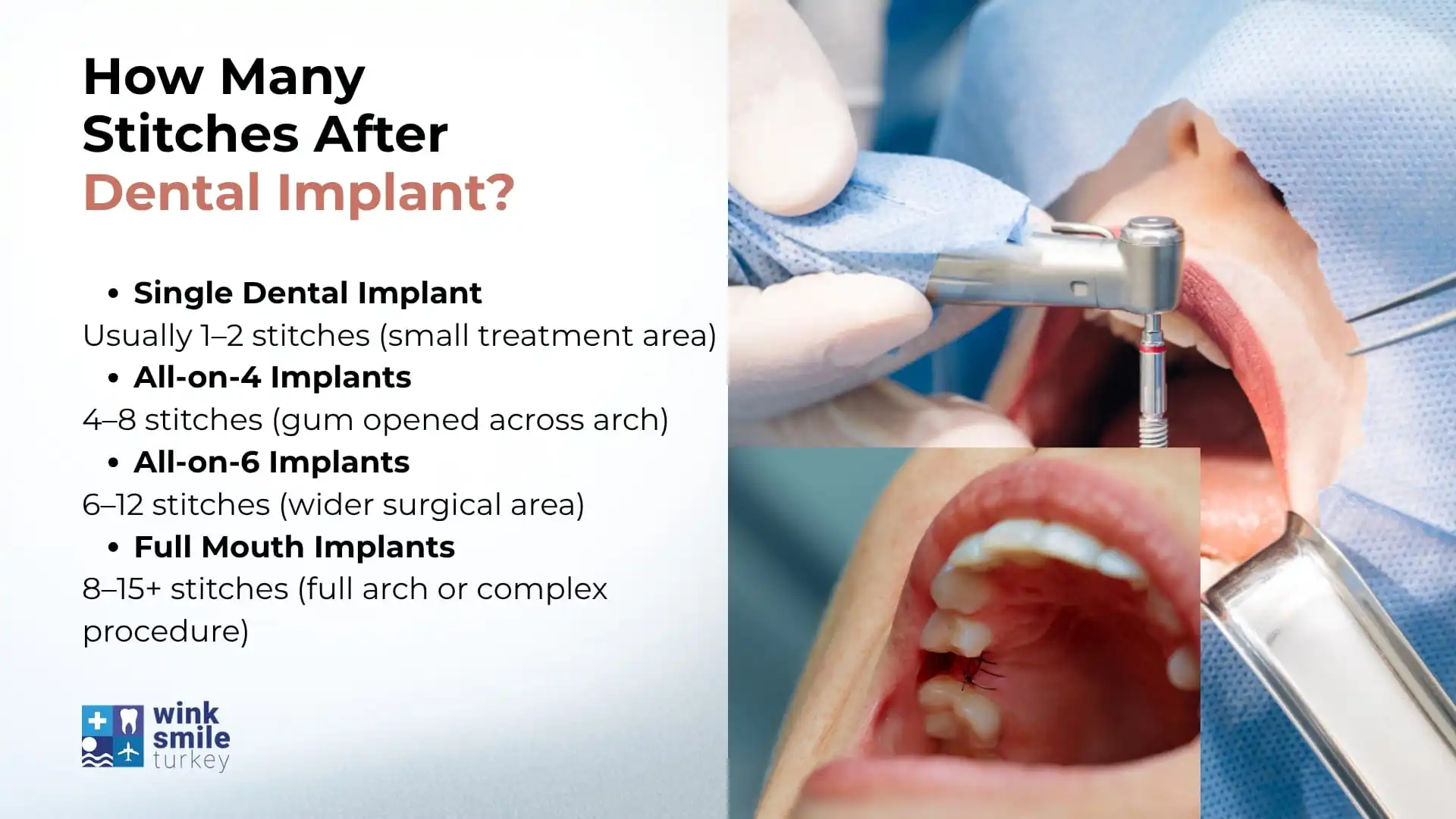 How Many Stitches After Dental Implant?