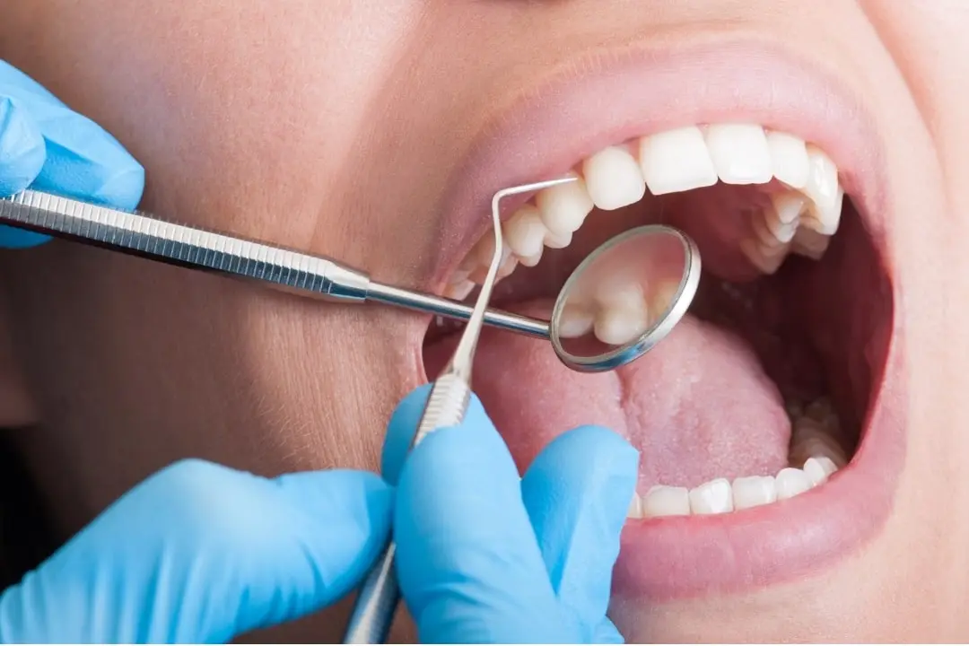 How to eliminate tartar on teeth?