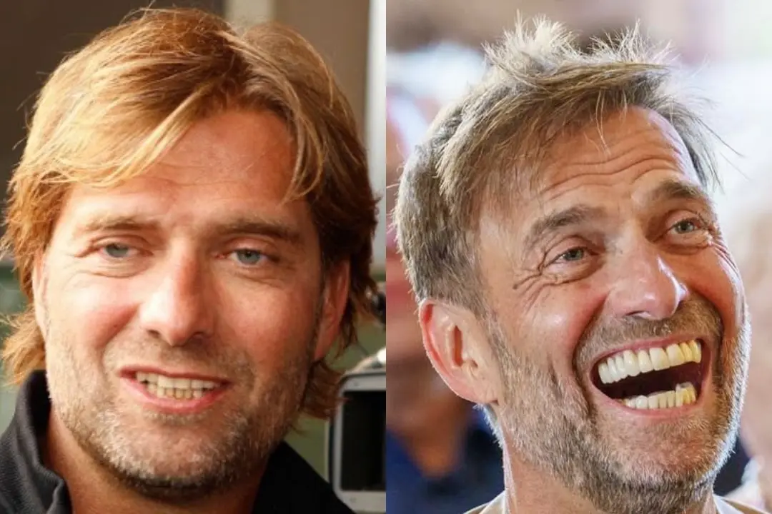 Jürgen Klopp's teeth before and after