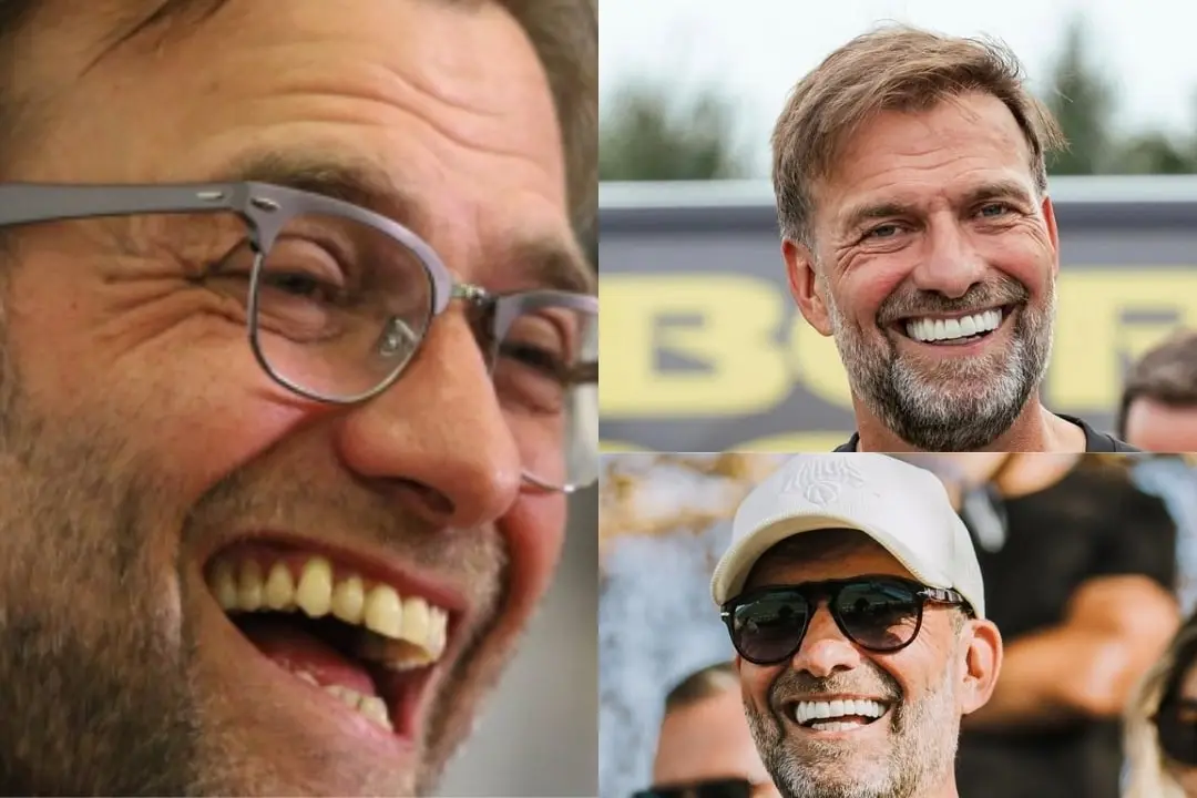 Jürgen Klopp's teeth before and after