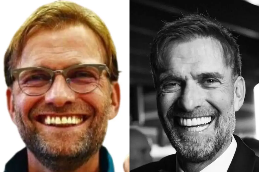 Jürgen Klopp's teeth before and after