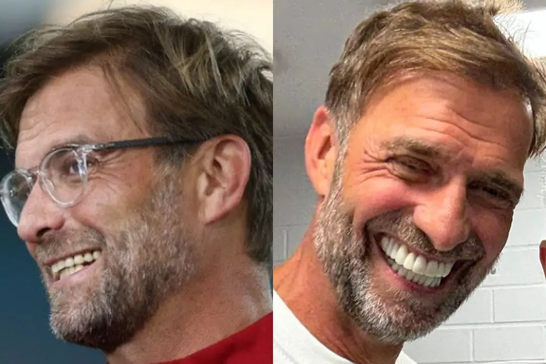 Jürgen Klopp's teeth before and after