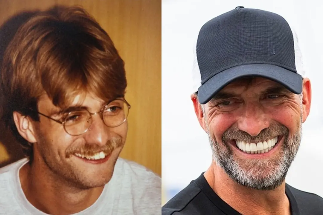 Jürgen Klopp teeth