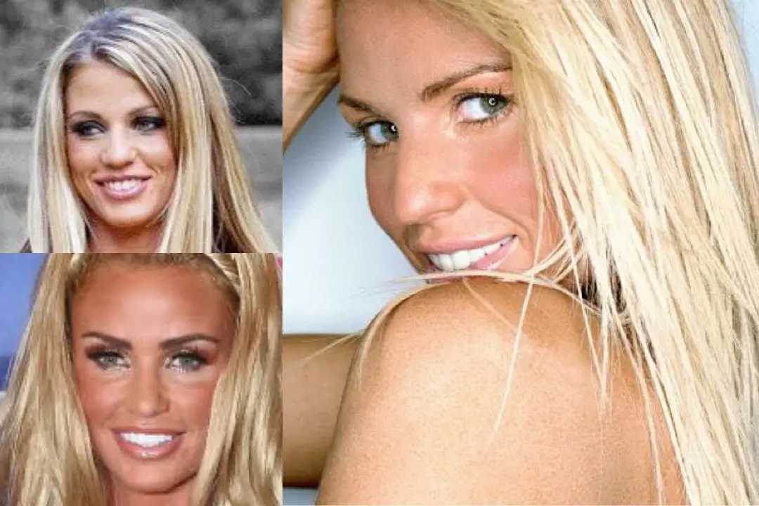 Katie Price teeth before and after