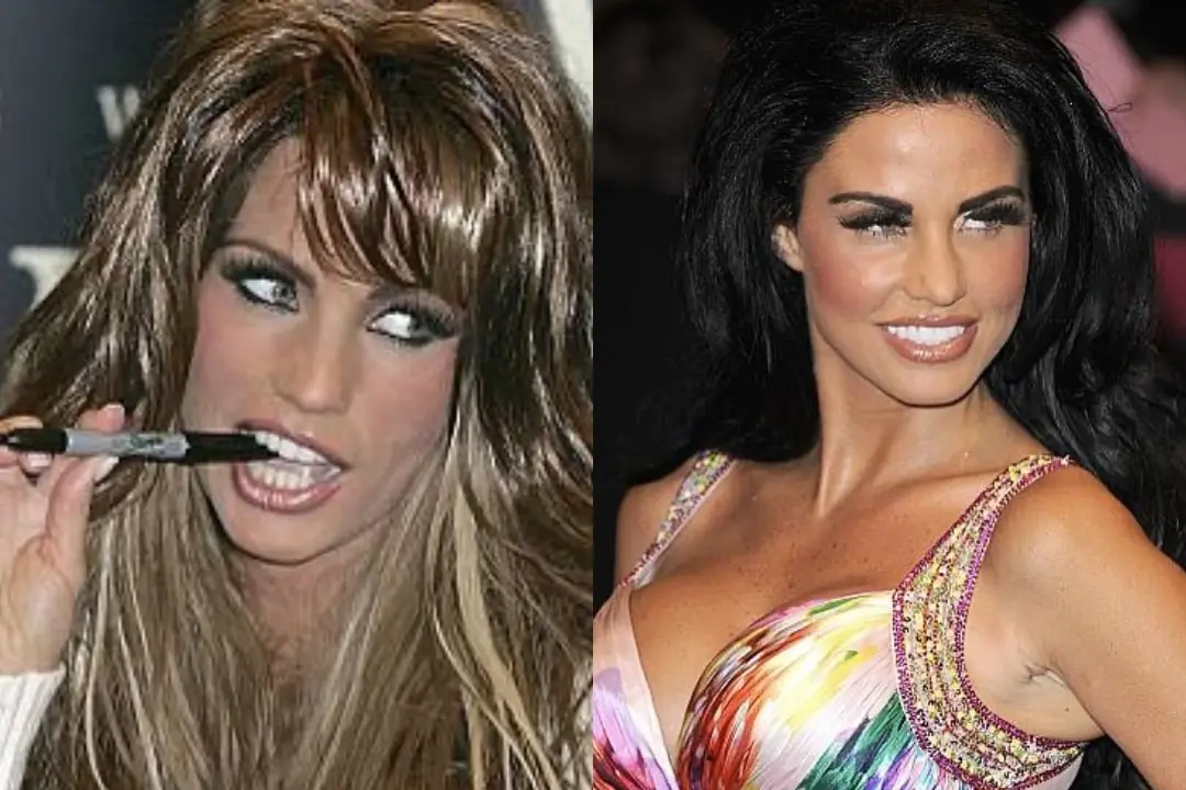 Katie Price teeth before and after