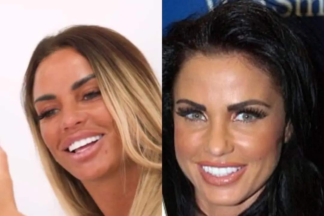 Katie Price teeth before and after