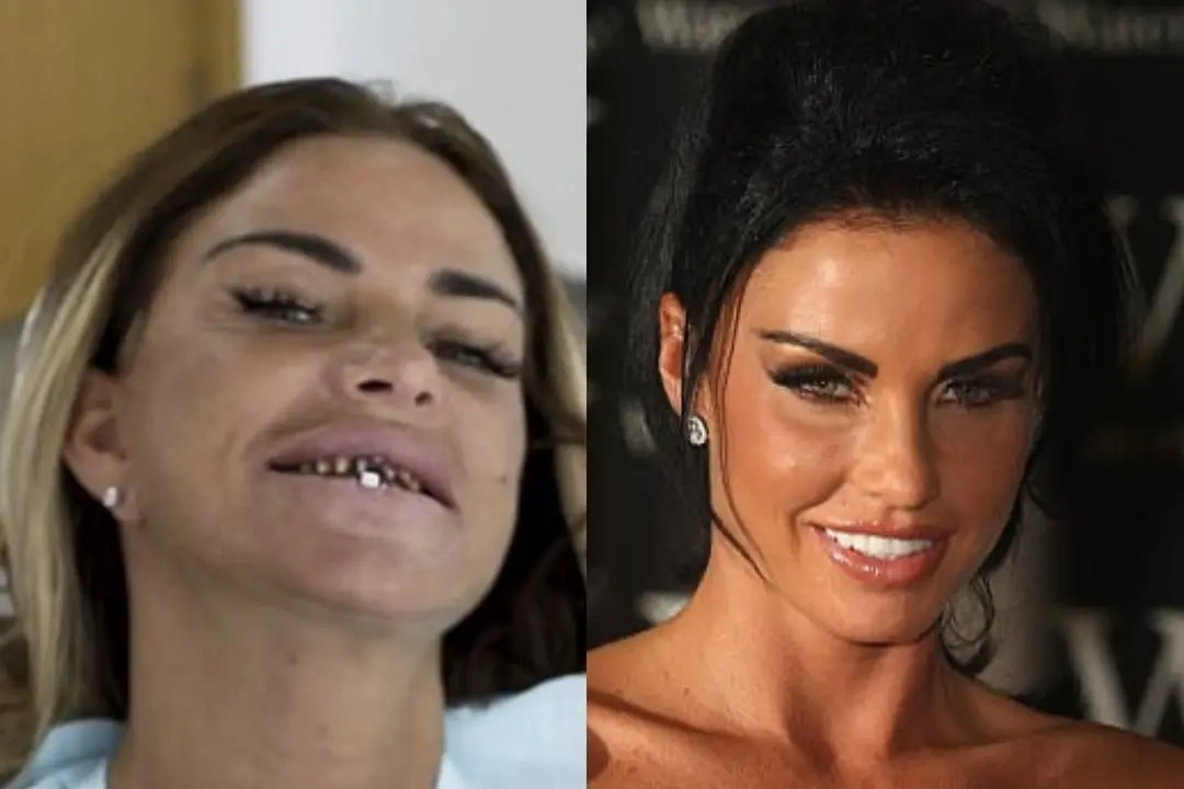 Katie Price teeth before and after