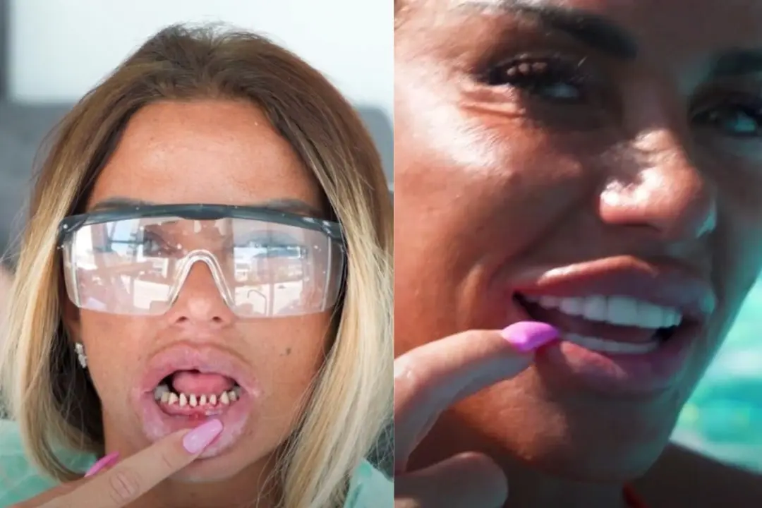 Katie Price teeth before and after
