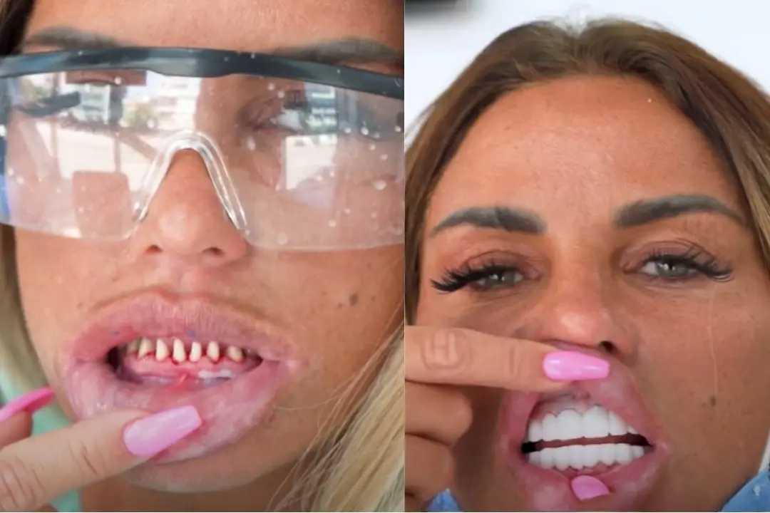 Katie Price teeth before and after