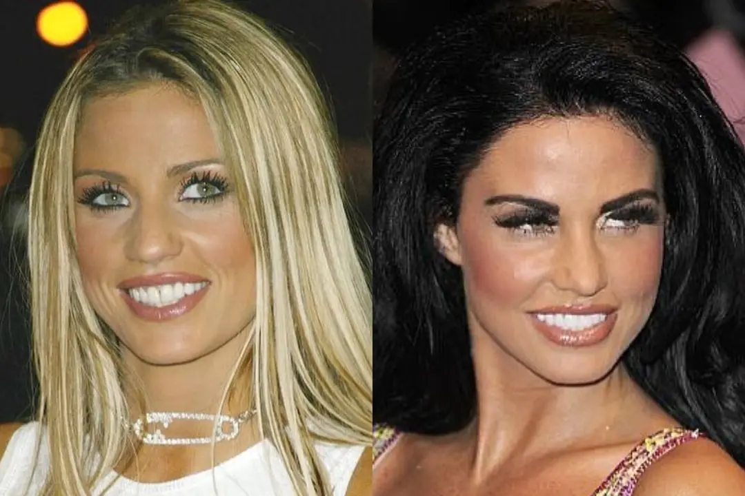 Katie Price teeth before and after