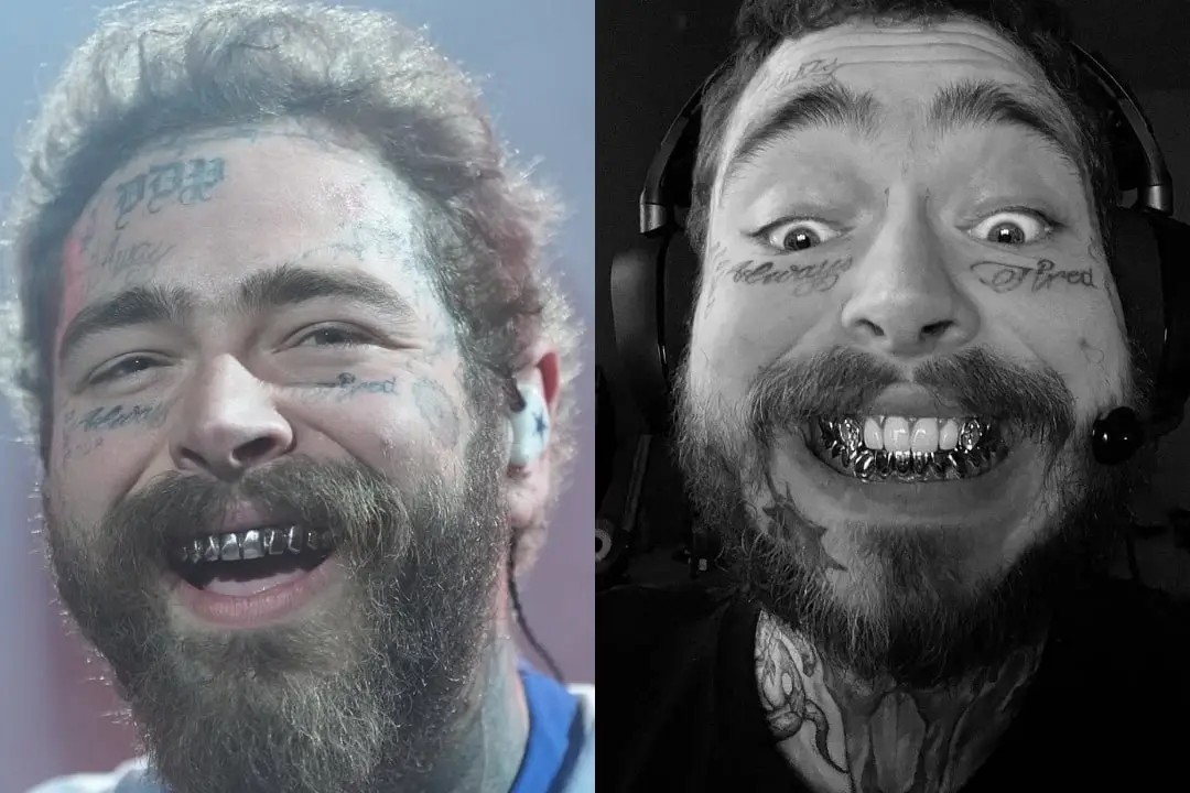 Post Malone's teeth before and after