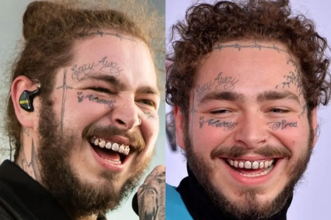 Post Malone's teeth before and after