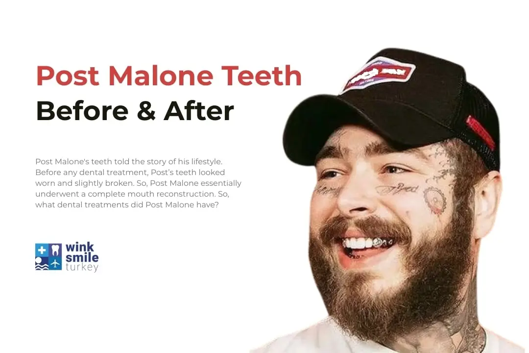 Post Malone Teeth Before and After
