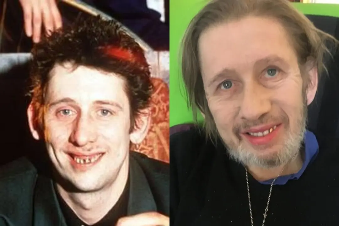 Shane MacGowan teeth before after