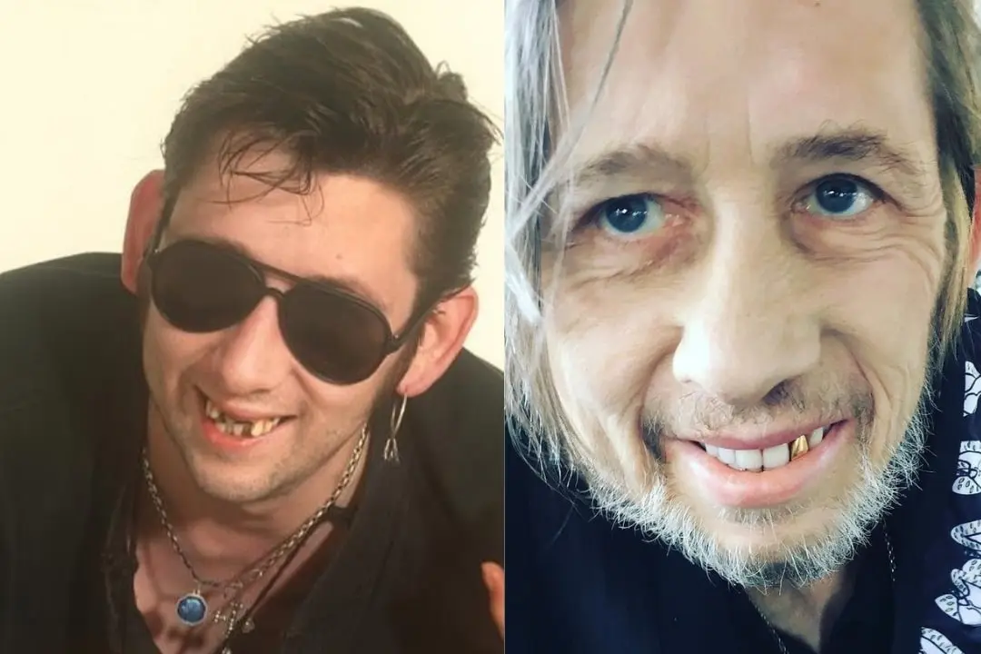 Shane MacGowan teeth before after