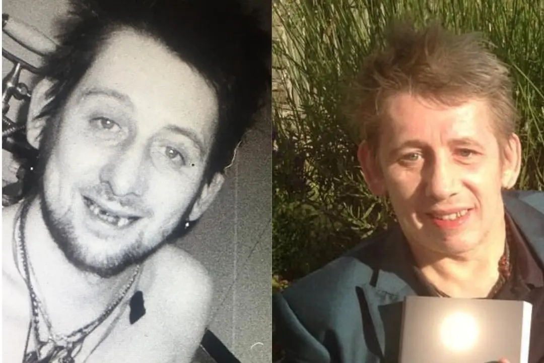 Shane MacGowan teeth before after