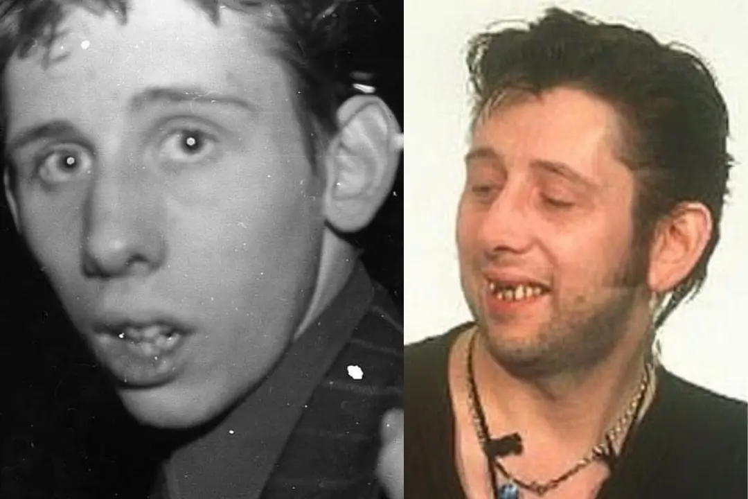 Shane MacGowan teeth before after
