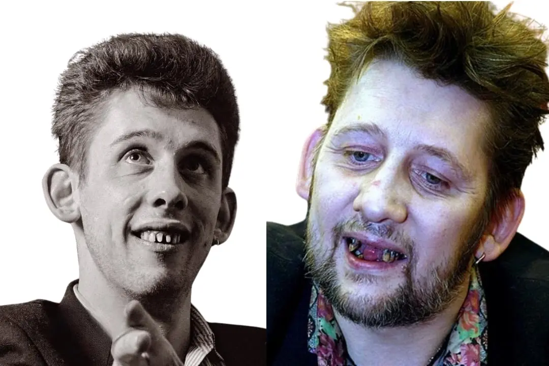 Shane MacGowan teeth before after