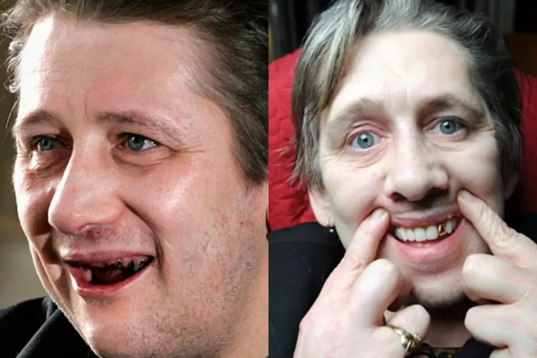 Shane MacGowan teeth before after