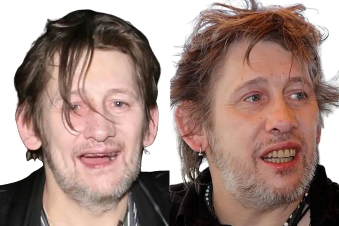 Shane MacGowan teeth before after