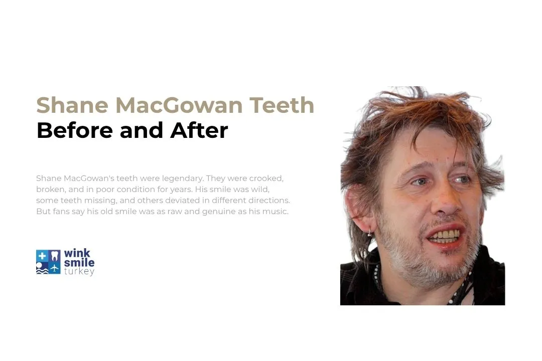 Shane MacGowan teeth before after